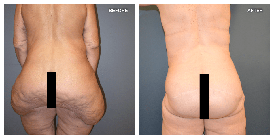 Lower Body Lift and Panniculectomy, female, age 51, 7 years after surgery by J. Peter Rubin, MD